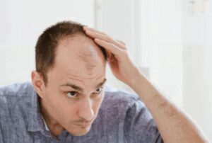 Perte de cheveux chez l'homme